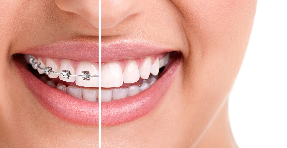 Metal Braces at Rehan Dental Surgery are the most common orthodontic appliance, Today’s braces are more comfortable and more efficient than ever before. 