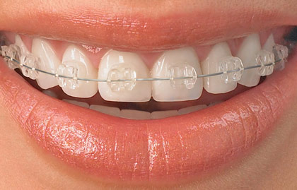 Clear Braces for  teenageand adults who are concerned about cosmetics 