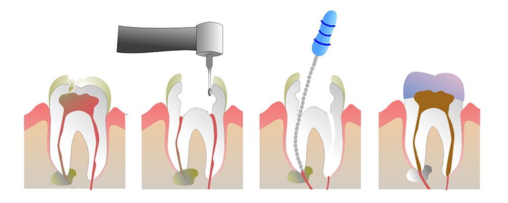 root Canal