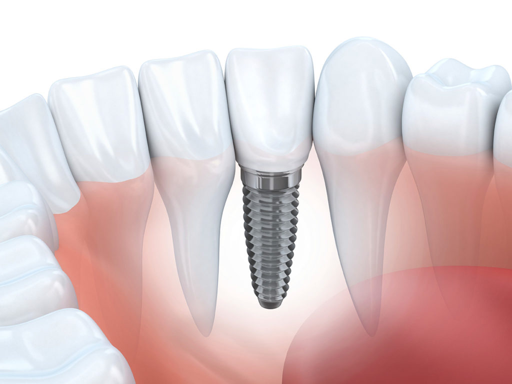 Complete Range of Dental Implants