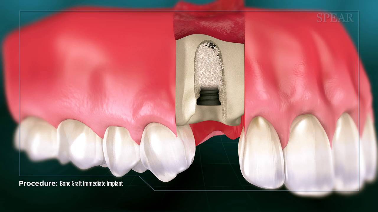 Bone Grafts at Rehan Dental Surgery is a surgical procedure by which new bone or a replacement material is placed into spaces between or around broken bone or holes in bone to aid in healing. Most bone grafts are expected to be reabsorbed and replaced as the natural bone heals over a few months’ time.
