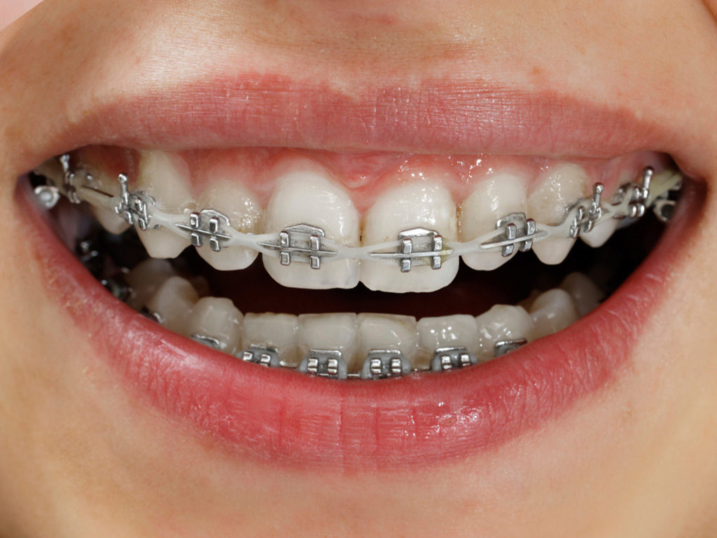 elastic rubber for braces