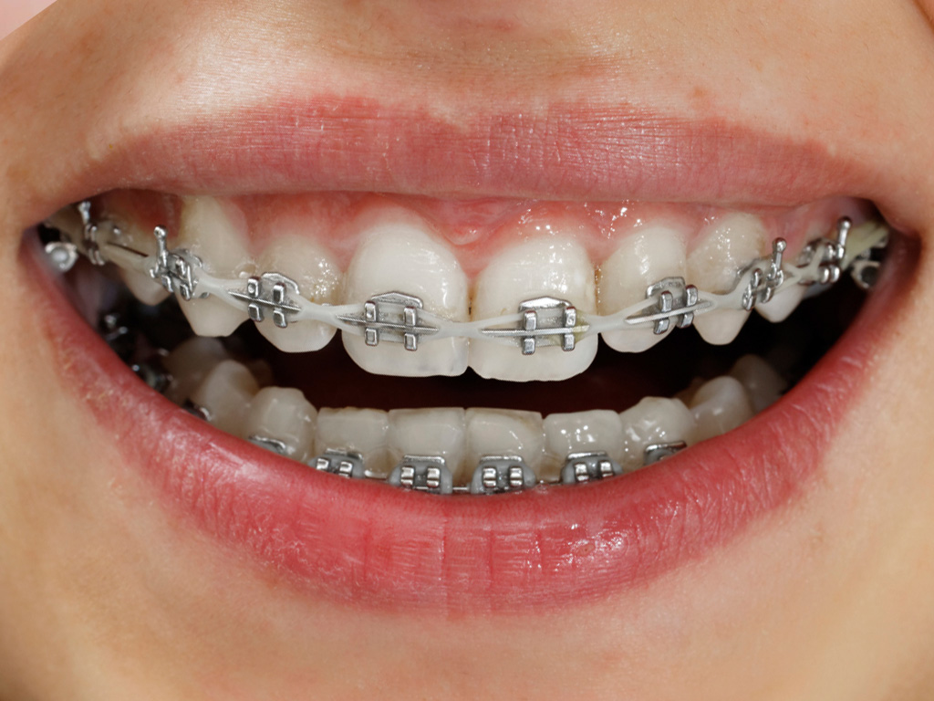 Complete Treatment of Orthodontics