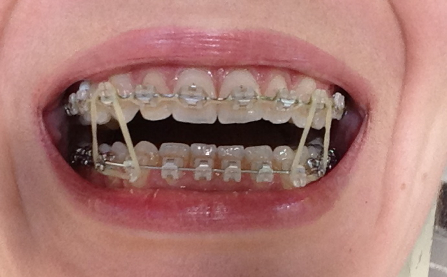 types of rubber bands for braces