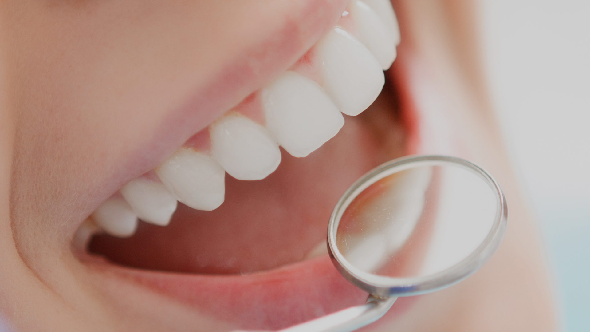 Benefits of professional teeth whitening