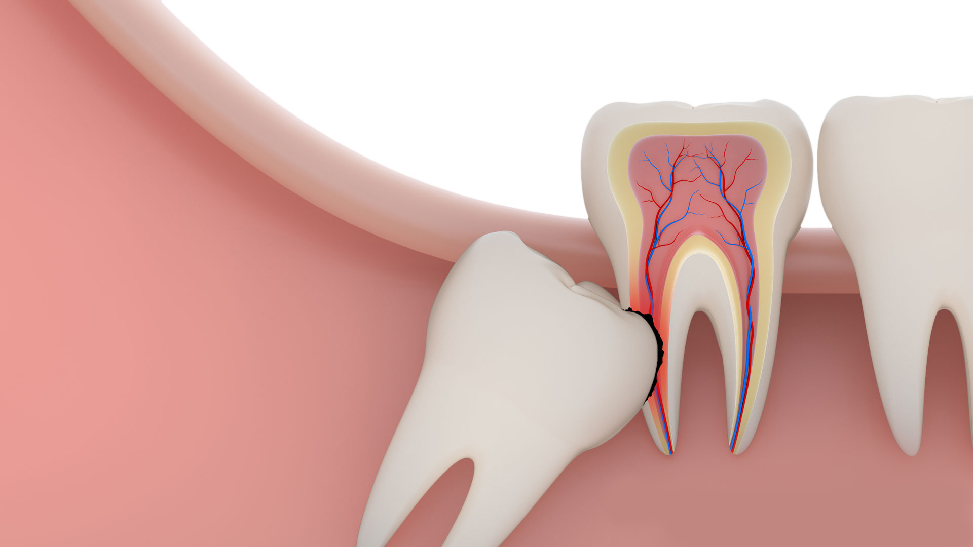 Wisdom Tooth Removal at Rehan Dental Surgery