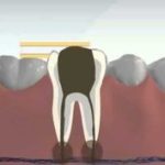 Root Canal Treatment and procedure is mostly complex, depending on the situation and may require a number of visits over a span of weeks. Therefore, root canals treatment is needed by patient who have a infection deep in the roots of the teeth. 
