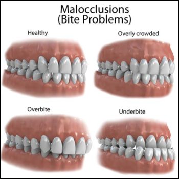 bite-problems-malocclusions