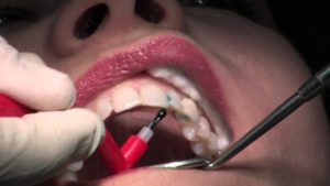 dental fillings