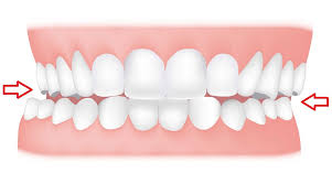Dental Crossbite Treatment