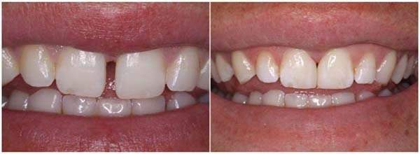 diastema-before and after
