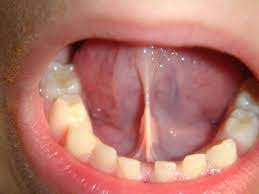 diastema- tongue tie
