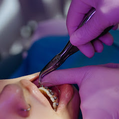 Adult-orthodontic-treatment
