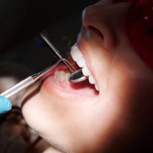 Professional-Dental-Cleaning-at-Rehan-Dental-Surgery