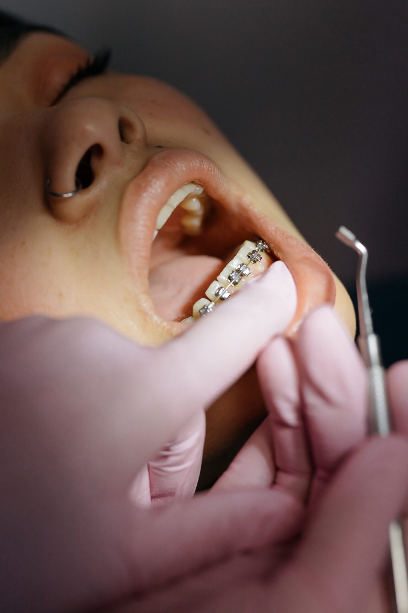 Adult-orthodontic-treatment