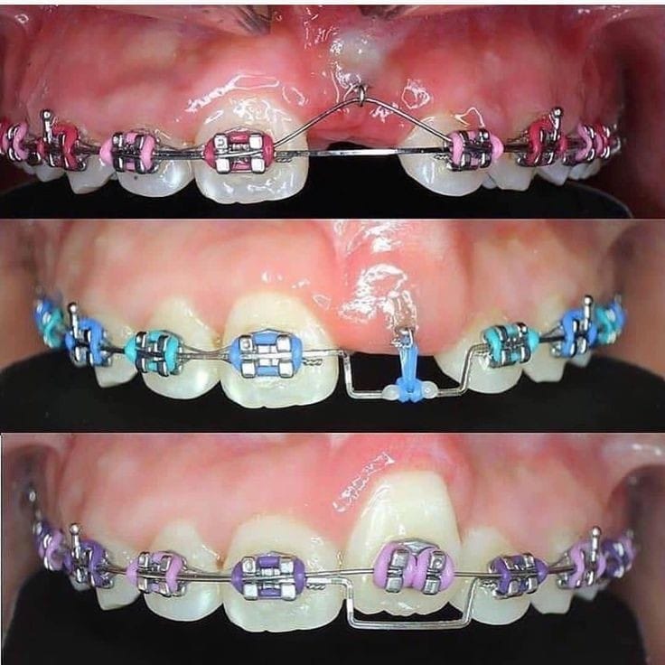 metal-braces-at-Rehan-dental-surgery