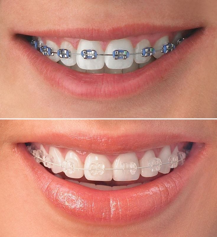 type-of-braces-at-Rehan-dental-surgery.