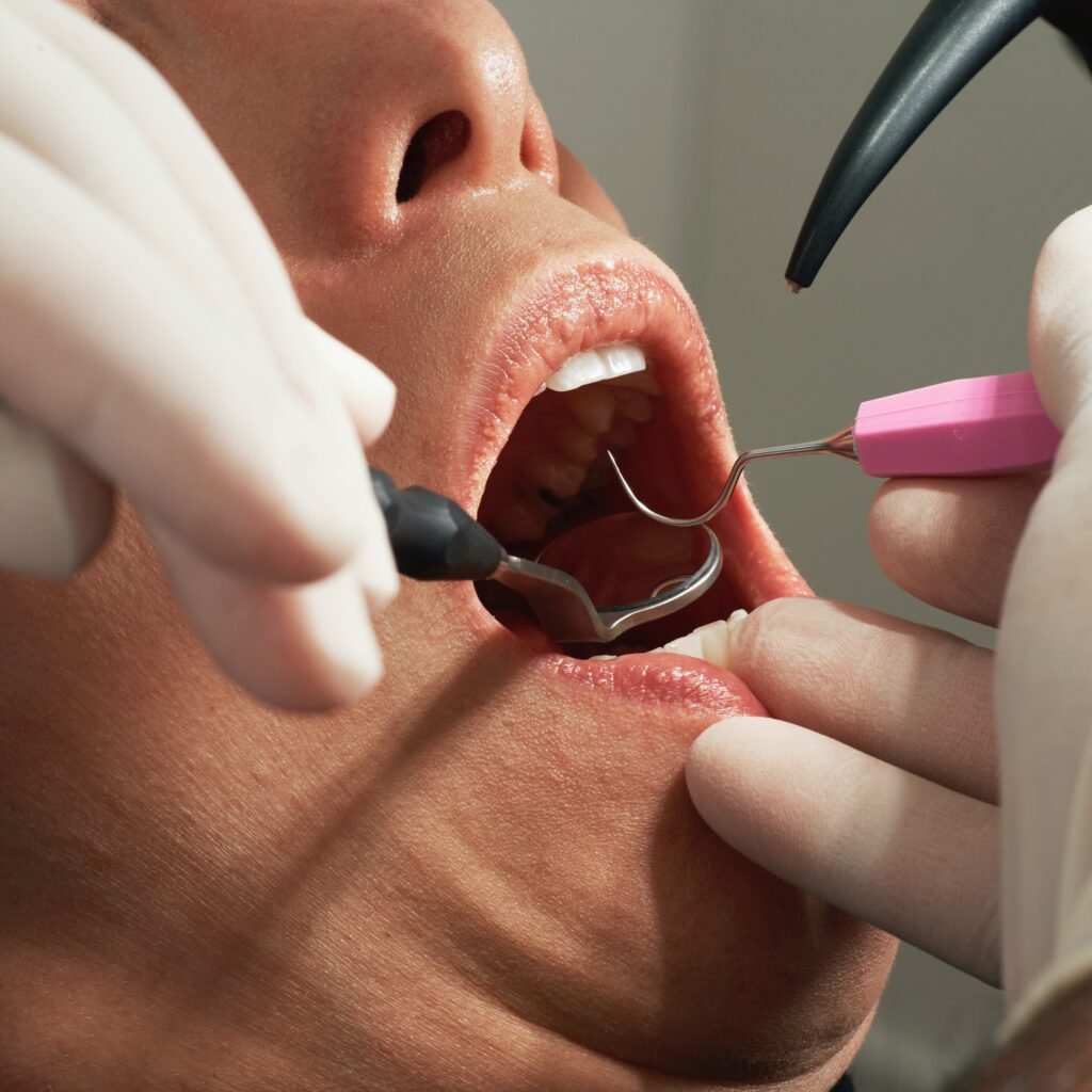 Gum-Disease-Treatment-Rehan-Dental-Surgery.jpeg