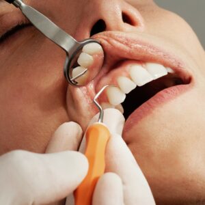 Professional-dental-cleaning Rehan-Dental-Surgery.