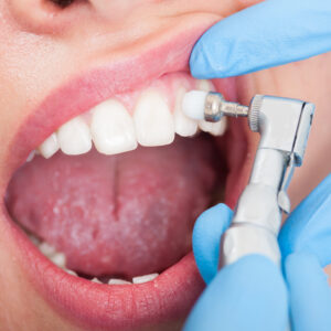 Teeth-whitening-Rehan-Dental-Surgery