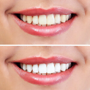 Teeth-whitening-Rehan-Dental-Surgery