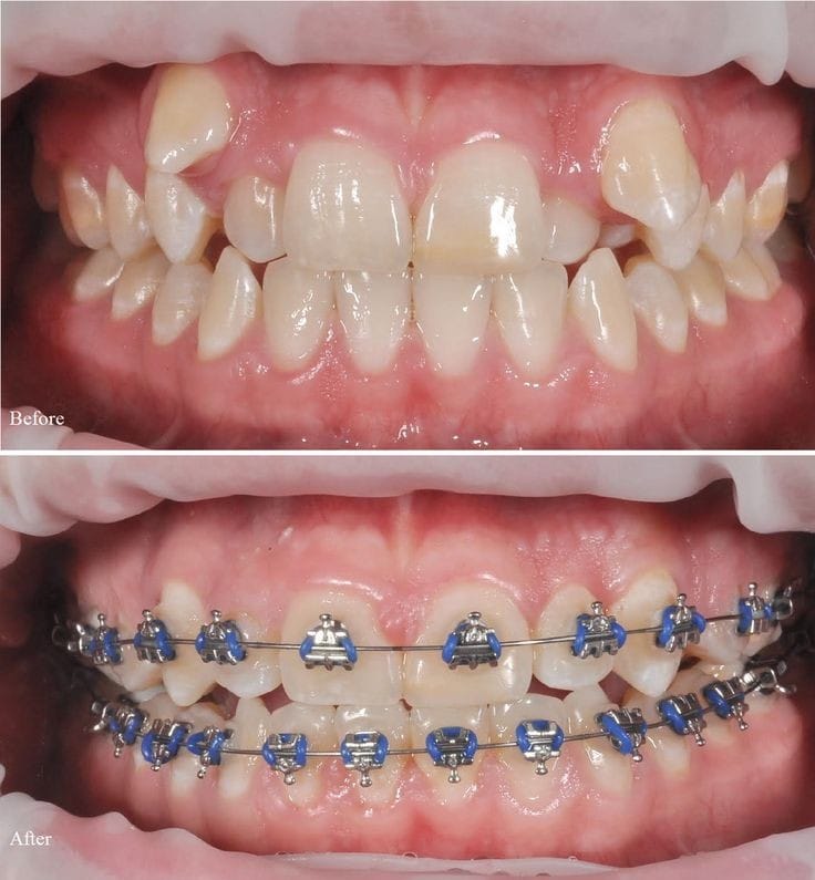 metal-braces-at-Rehan-dental-surgery