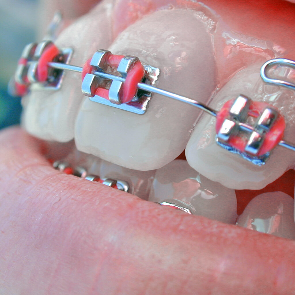 metal-braces-at-Rehan-Dental-surgery