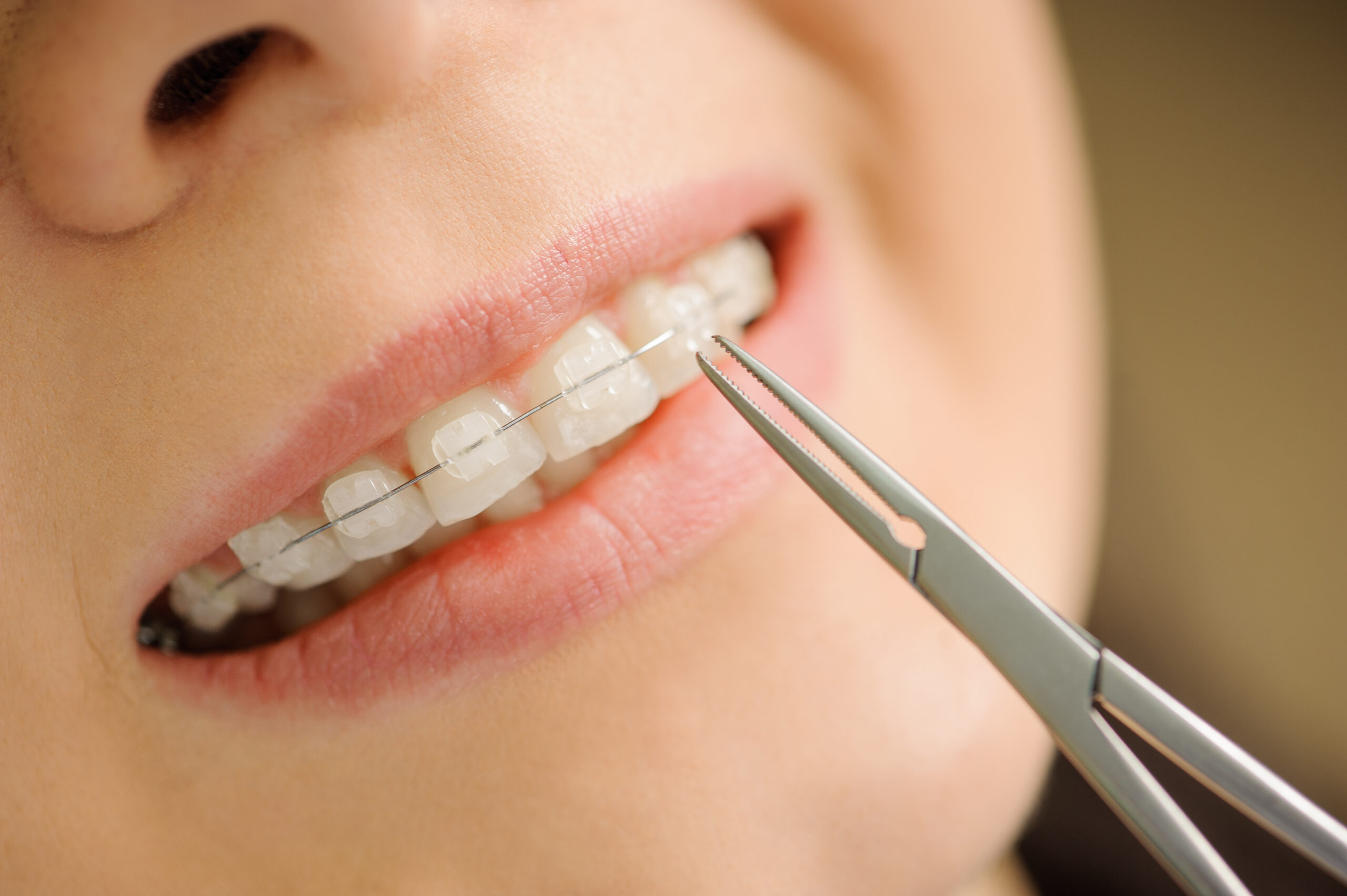 orthodontic-Treatment-at-Rehan-Dental-surgery